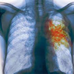 Туберкулинодиагностика - основное в  выявлении и профилактике туберкулеза